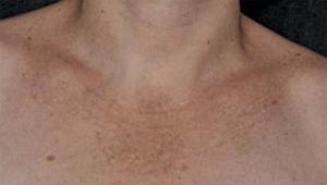 Тъмни петна по шията, гърдите или торса