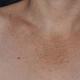 Темні плями на шиї, грудях чи тулубі