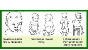 Příčiny, příznaky, léčba a prevence křivice u dětí